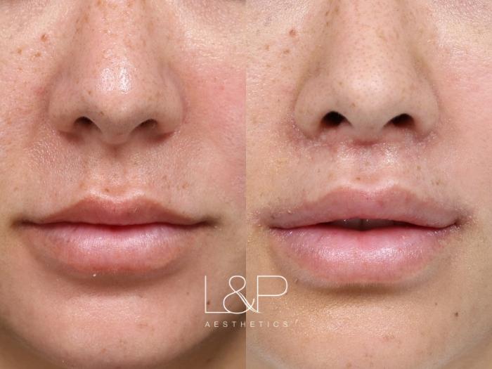 Lip Lift and Corner Lip Lift for More Volume and Youthful Appearance