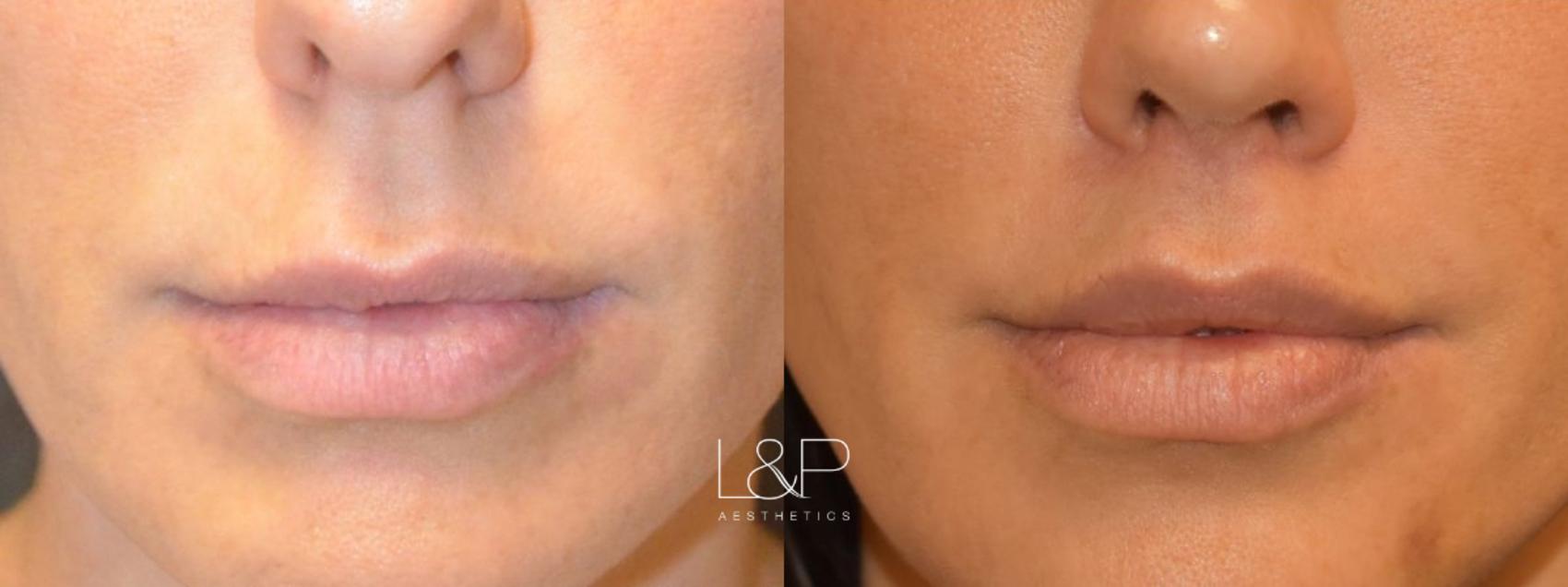 Before & After Lip Lift Case 70 Front View in Palo Alto & San Jose, California