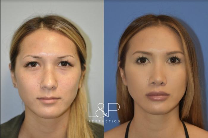 Before & After Lip Lift Case 71 Front View in Palo Alto & San Jose, California