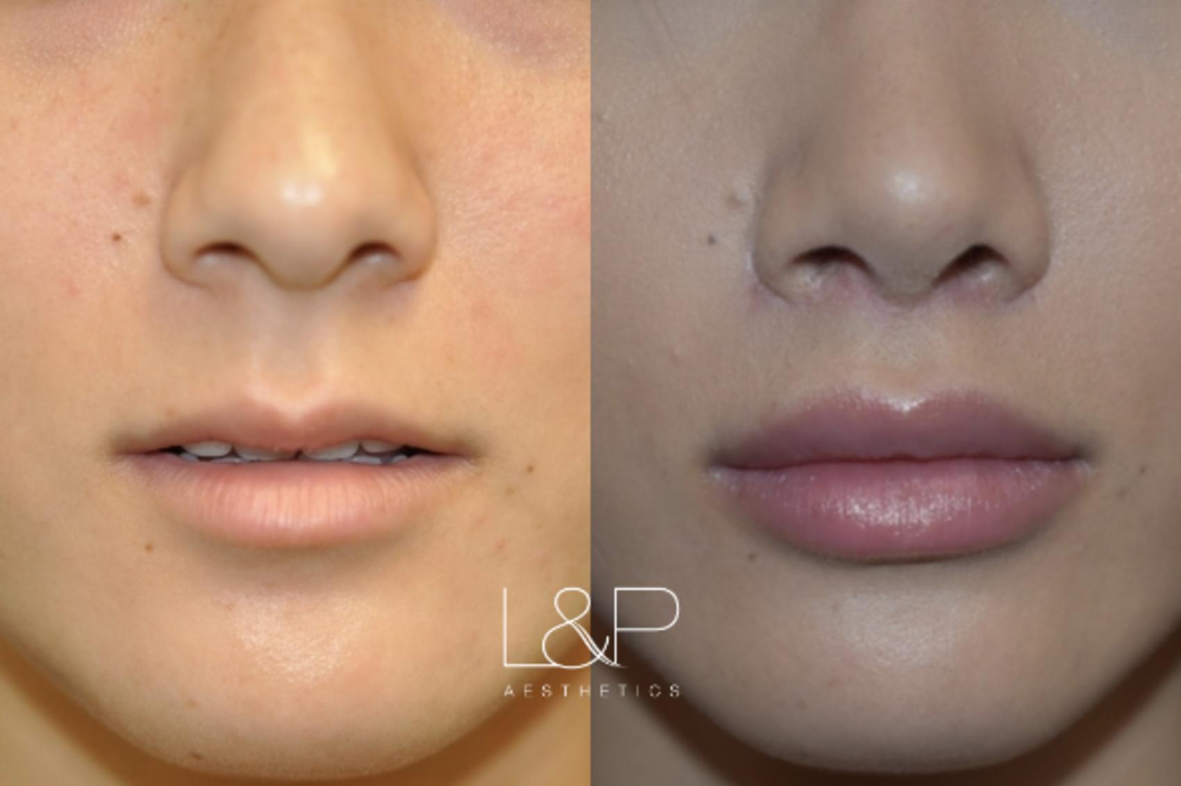 Before & After Lip Lift Case 71 View 2 View in Palo Alto & San Jose, California