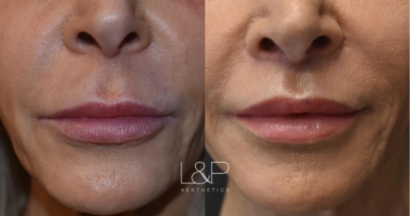 Before & After Lip Lift Case 72 Front View in Palo Alto & San Jose, California