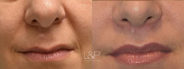 Before & After Lip Lift Case 73 Front View in Palo Alto & San Jose, California