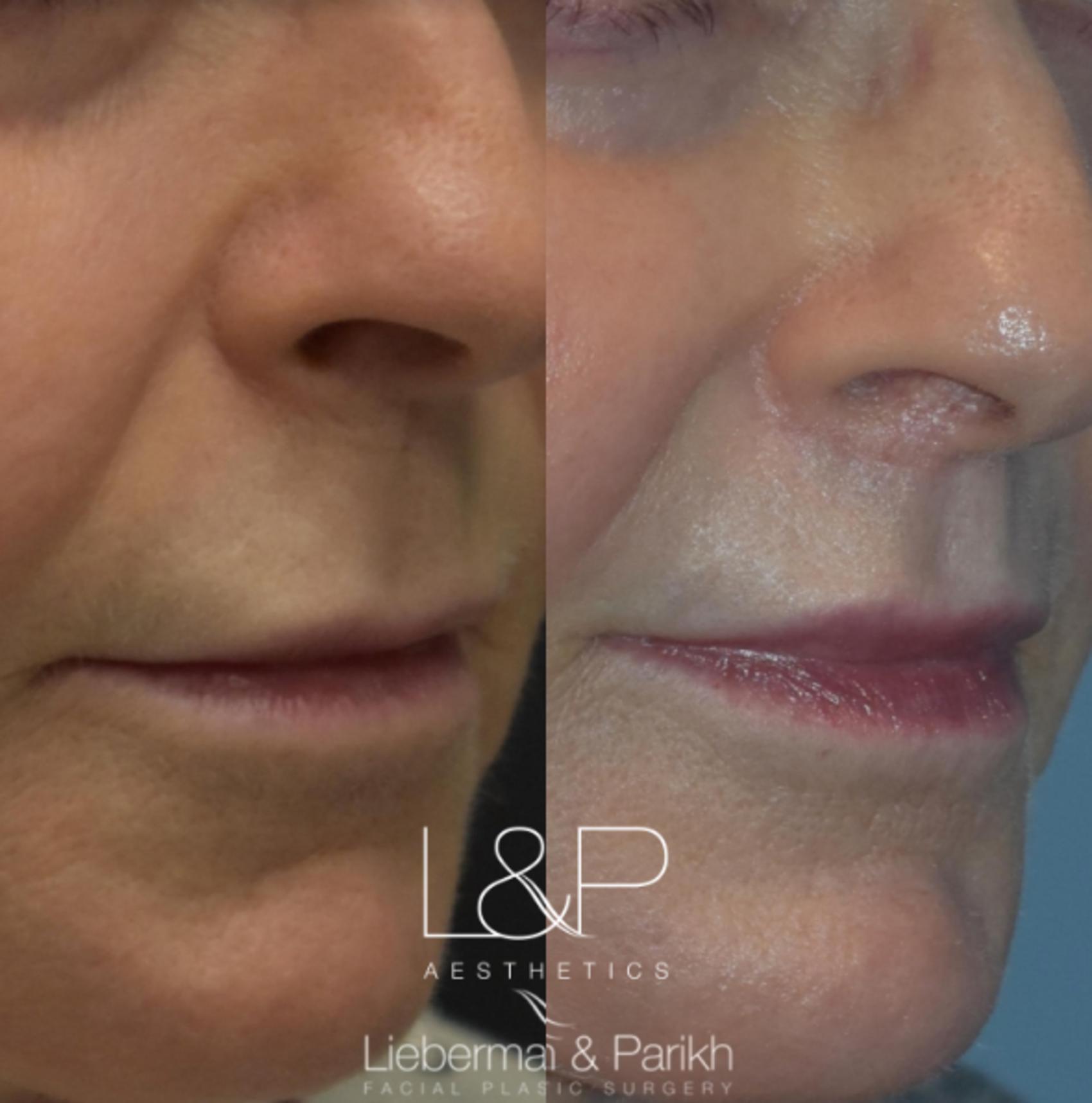 Before & After Lip Lift Case 73 Right Oblique View in Palo Alto & San Jose, California