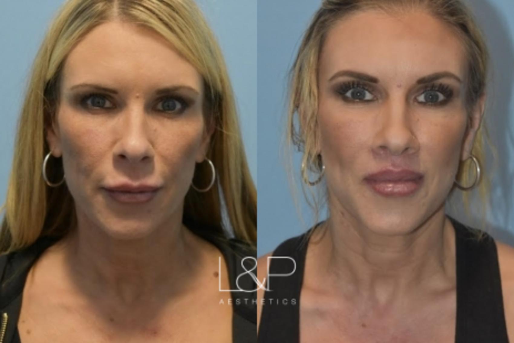 Before & After Lip Lift Case 74 Front View in Palo Alto & San Jose, California