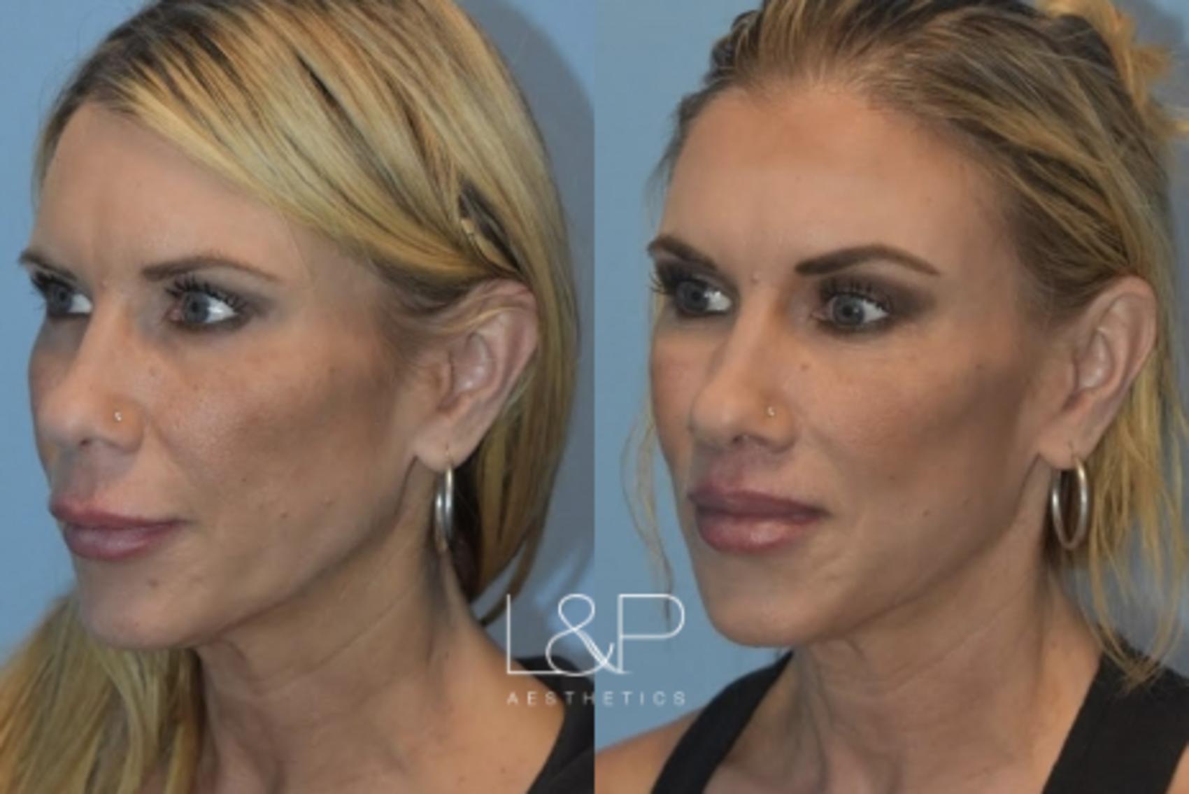 Before & After Lip Lift Case 74 Left Oblique View in Palo Alto & San Jose, California