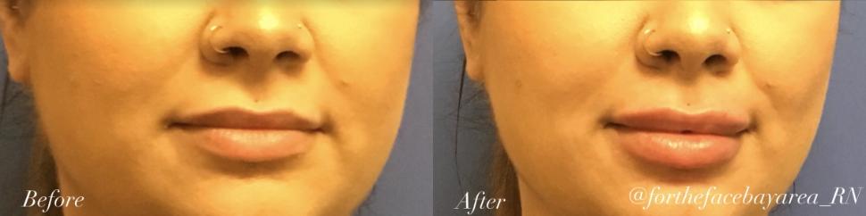 Before & After Lip Augmentation Case 91 Front View in Palo Alto & San Jose, California