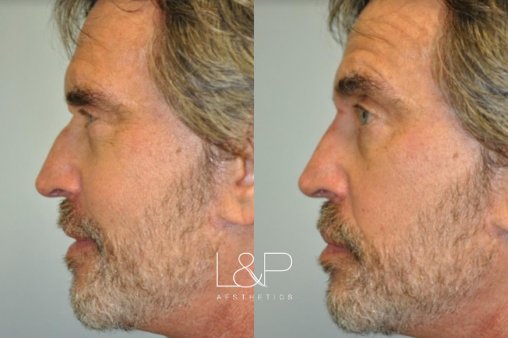 Before & After Liquid Rhinoplasty Case 106 Left Side View in Palo Alto & San Jose, California