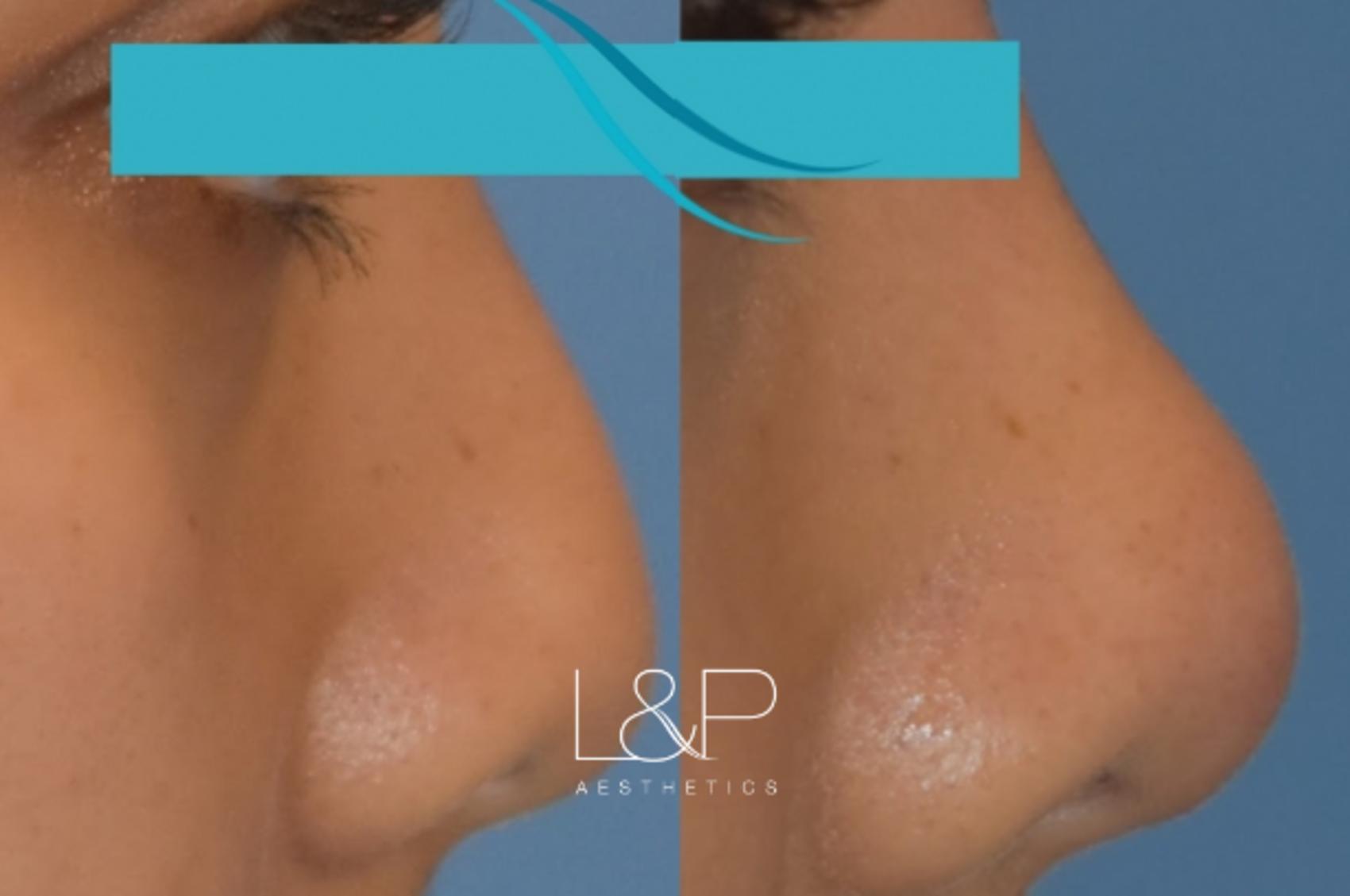 Before & After Liquid Rhinoplasty Case 107 Right Side View in Palo Alto & San Jose, California