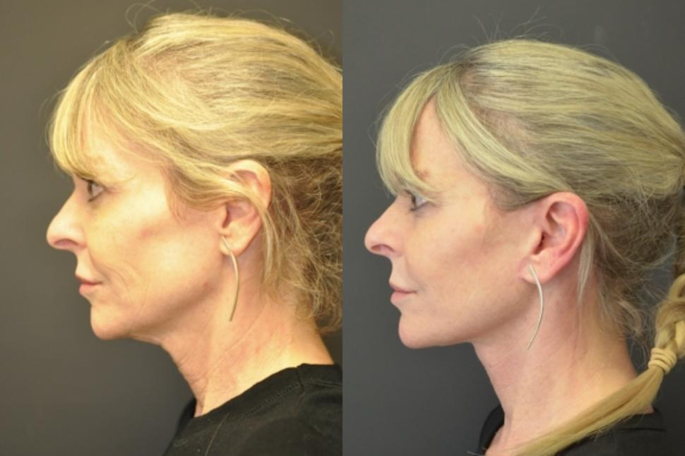 Before & After Facelift & Neck Lift Case 19 Left Side View in Palo Alto & San Jose, California