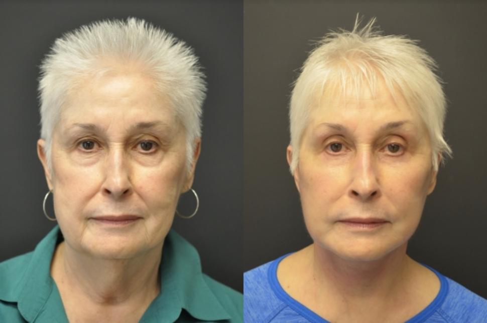 Before & After Facelift & Neck Lift Case 22 Front View in Palo Alto & San Jose, California