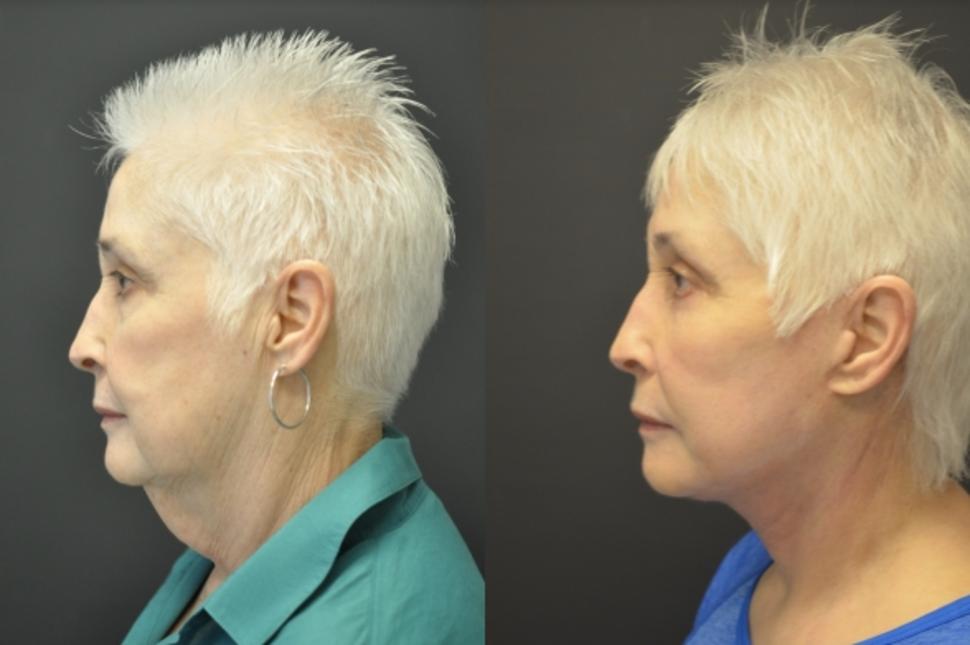 Before & After Facelift & Neck Lift Case 22 Left Side View in Palo Alto & San Jose, California