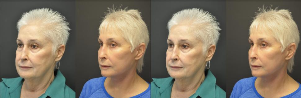 Before & After Facelift & Neck Lift Case 22 Right Oblique View in Palo Alto & San Jose, California