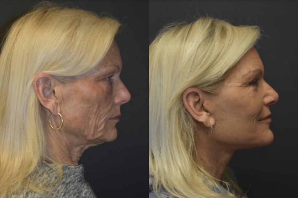 Before & After Facelift & Neck Lift Case 23 Right Side View in Palo Alto & San Jose, California