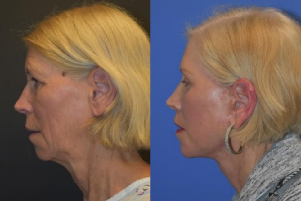 Before & After Facelift & Neck Lift Case 25 Left Side View in Palo Alto & San Jose, California
