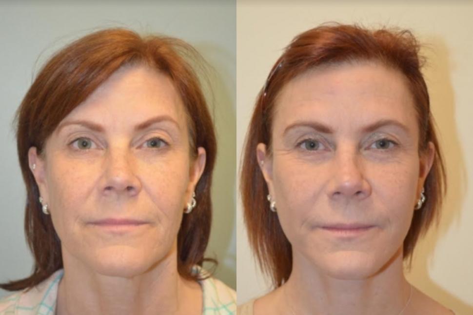 Before & After Facelift & Neck Lift Case 27 Front View in Palo Alto & San Jose, California
