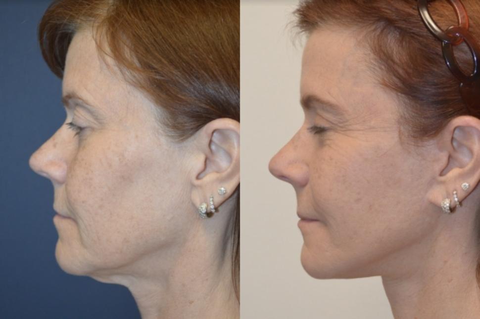 Before & After Facelift & Neck Lift Case 27 Left Side View in Palo Alto & San Jose, California