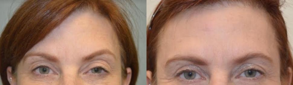 Before & After Facelift & Neck Lift Case 27 View 3 View in Palo Alto & San Jose, California