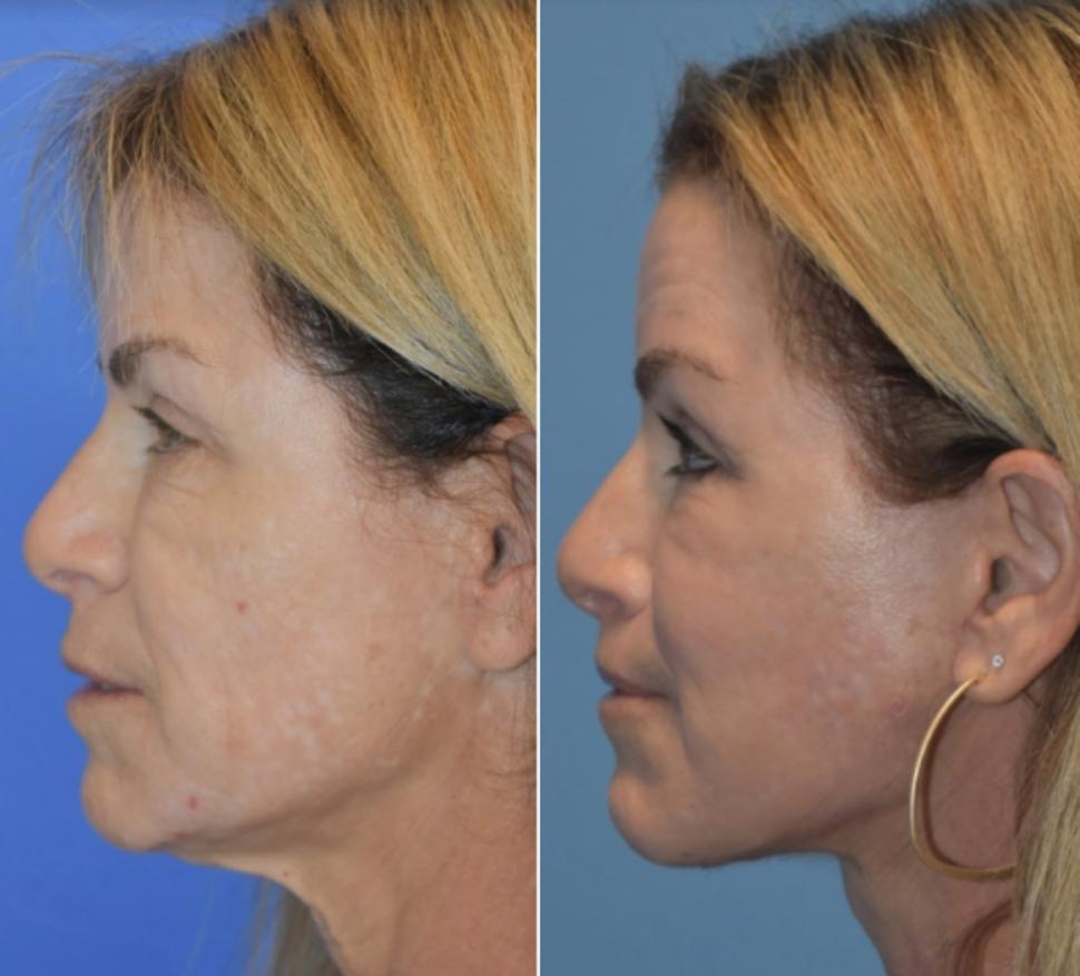 Before & After Facelift & Neck Lift Case 30 Left Side View in Palo Alto & San Jose, California