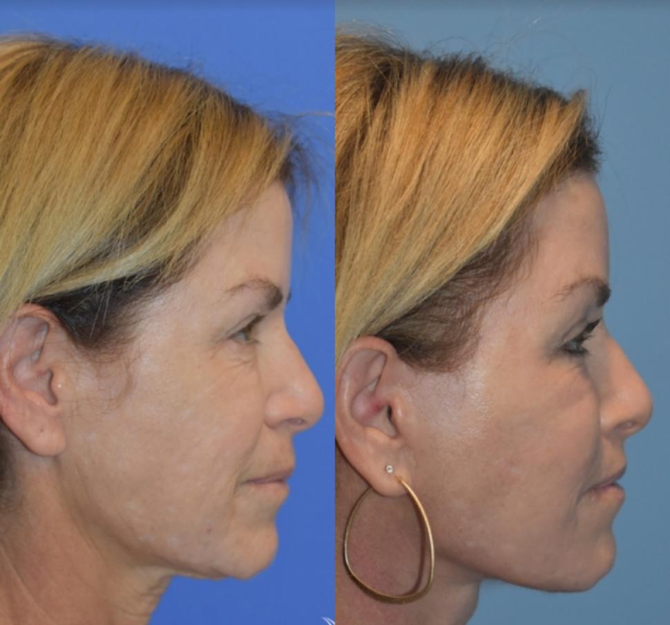 Before & After Facelift & Neck Lift Case 30 Right Side View in Palo Alto & San Jose, California