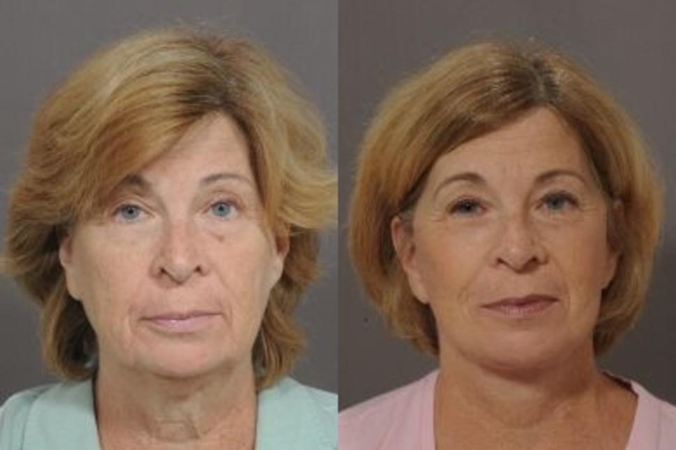 Before & After Facelift & Neck Lift Case 37 Front View in Palo Alto & San Jose, California