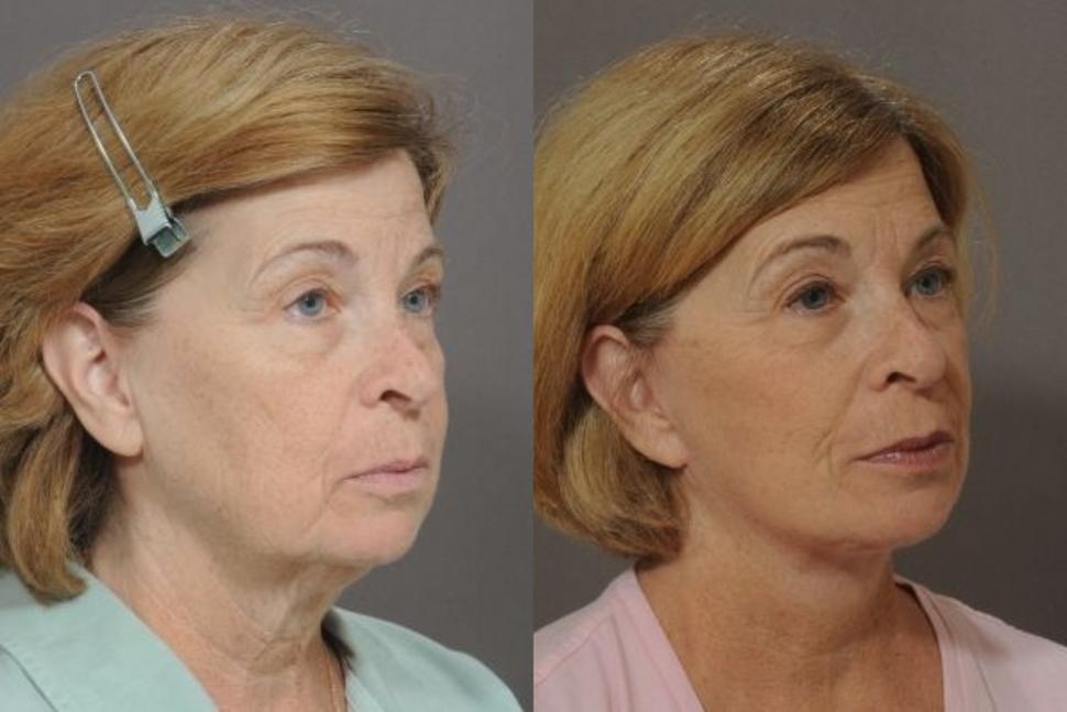 Before & After Facelift & Neck Lift Case 37 Right Oblique View in Palo Alto & San Jose, California