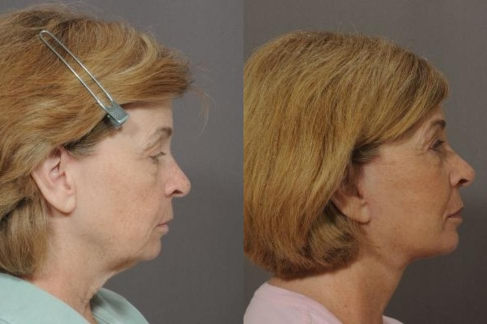 Before & After Facelift & Neck Lift Case 37 Right Side View in Palo Alto & San Jose, California