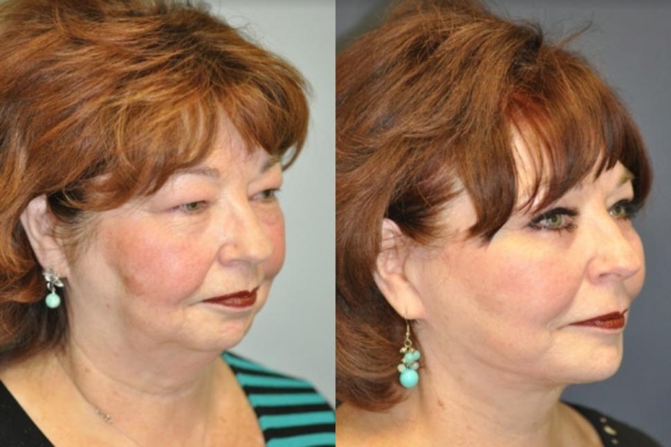 Before & After Facelift & Neck Lift Case 42 Right Oblique View in Palo Alto & San Jose, California
