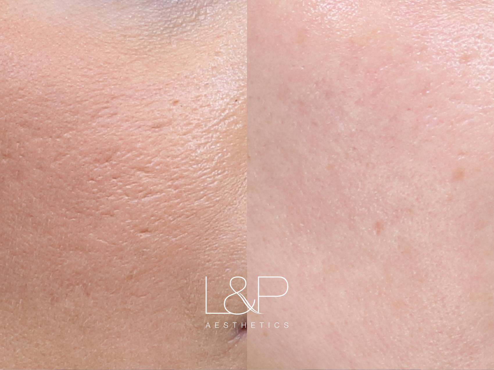 Microneedling Before and After 