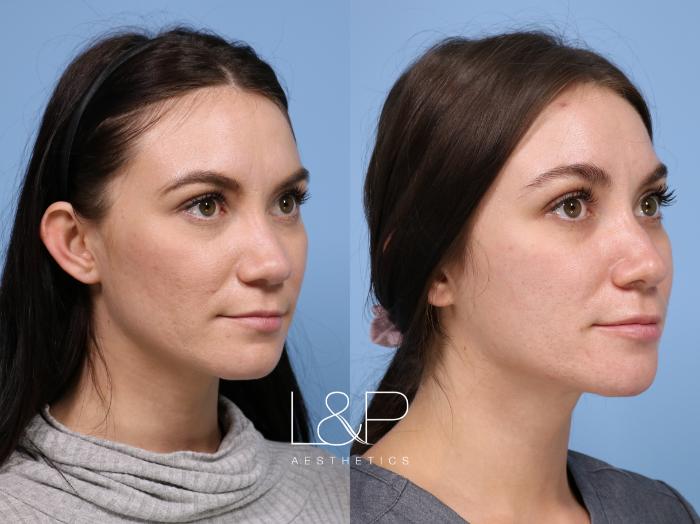 Right Side of Patient with Microneedling, Botox & Lip Filler