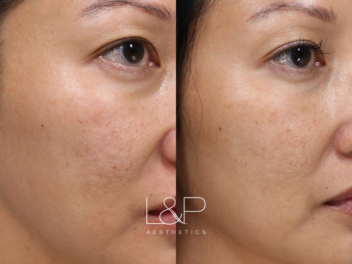 The Microneedling Rundown With Before and After Photos – Perfect Face  Aesthetic Medicine