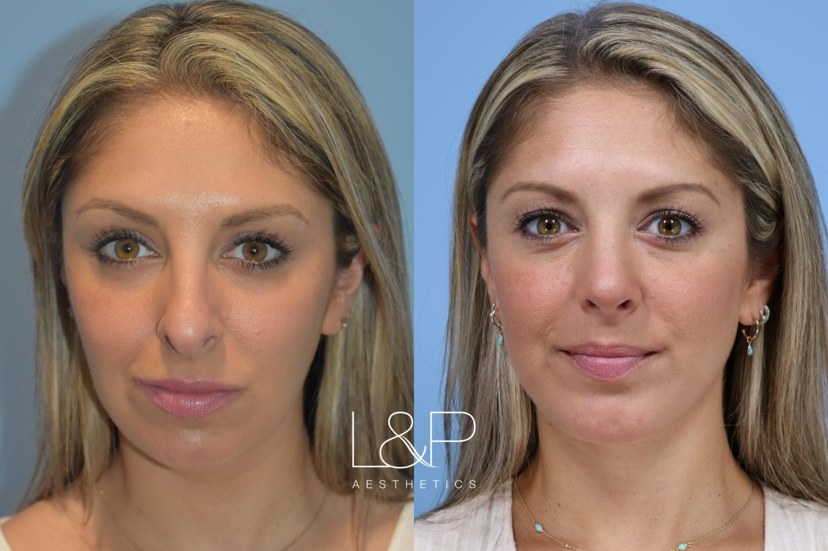 Before & After Midline Neck Lift Case 160 Front View in Palo Alto & San Jose, California