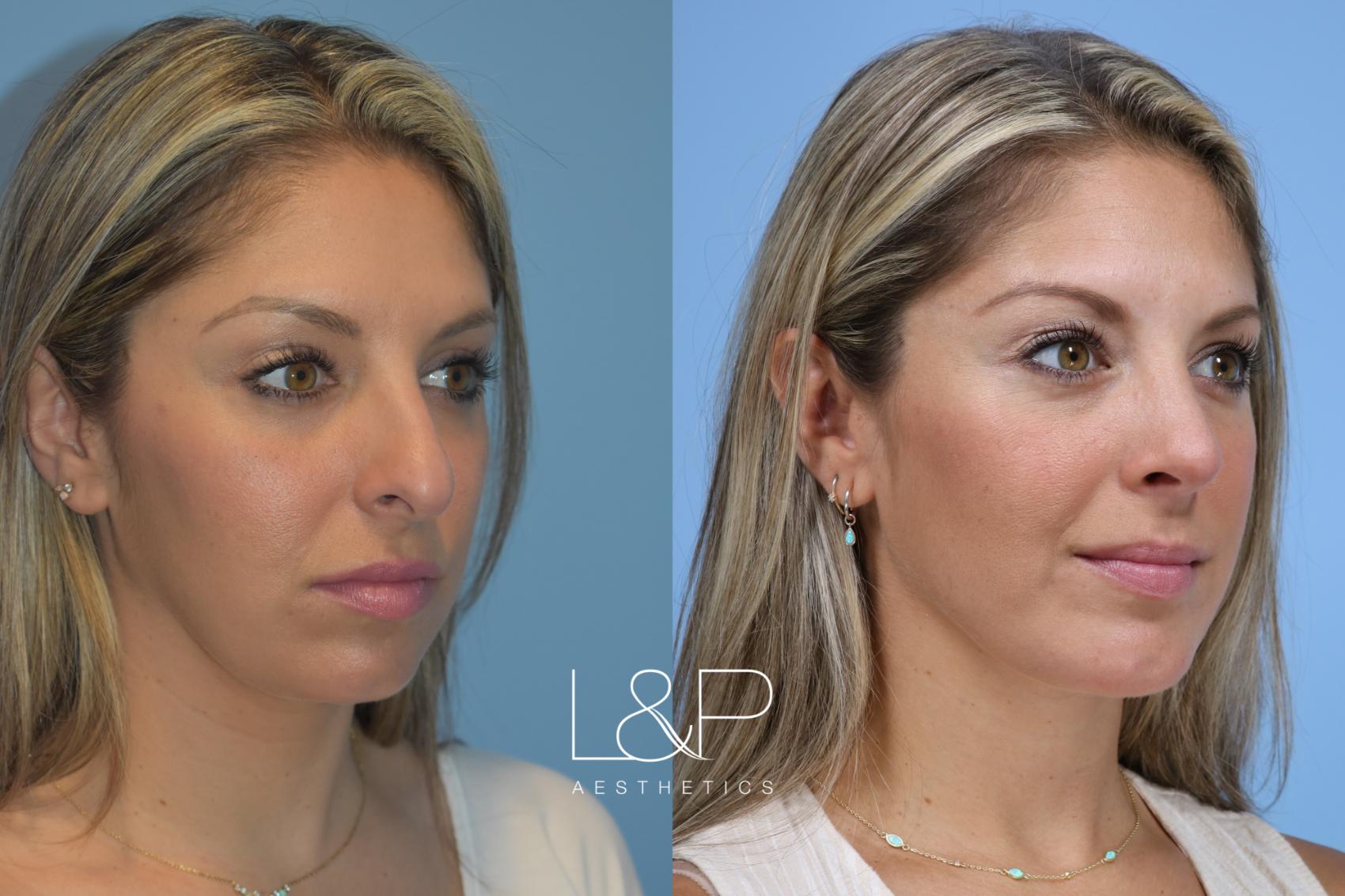 Before & After Midline Neck Lift Case 160 Right Oblique View in Palo Alto & San Jose, California