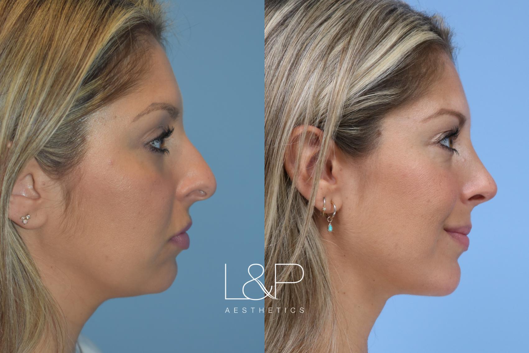 Before & After Midline Neck Lift Case 160 Right Side View in Palo Alto & San Jose, California
