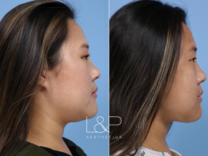 Young woman undergoes L&P Midline Neck Lift to address neck volume