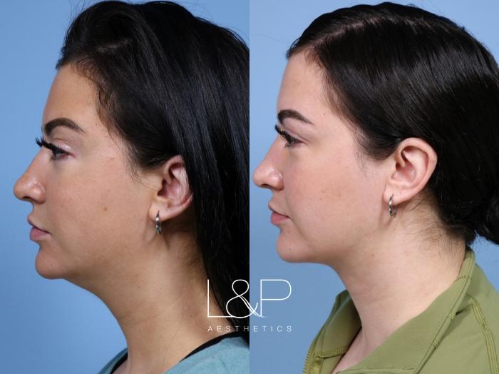 Midline Neck Lift for Young Bay Area Woman