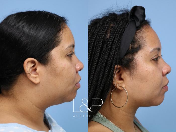 Neck rejuvenation with one procedure and one incision