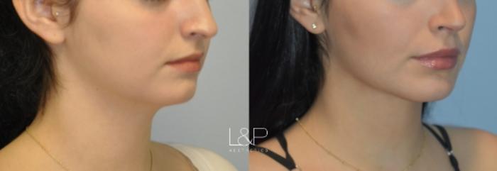 Before & After Midline Neck Lift Case 76 Right Oblique View in Palo Alto & San Jose, California