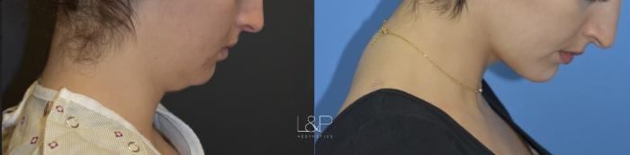 Before & After Midline Neck Lift Case 76 Right Side View in Palo Alto & San Jose, California