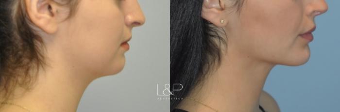 Before & After Midline Neck Lift Case 76 View 3 View in Palo Alto & San Jose, California