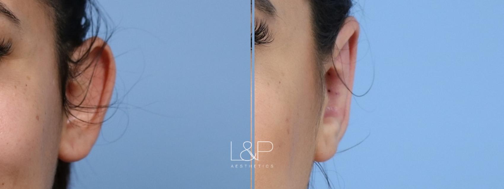 Otoplasty (Ear Surgery) for Palo Alto, Los Gatos & San Jose