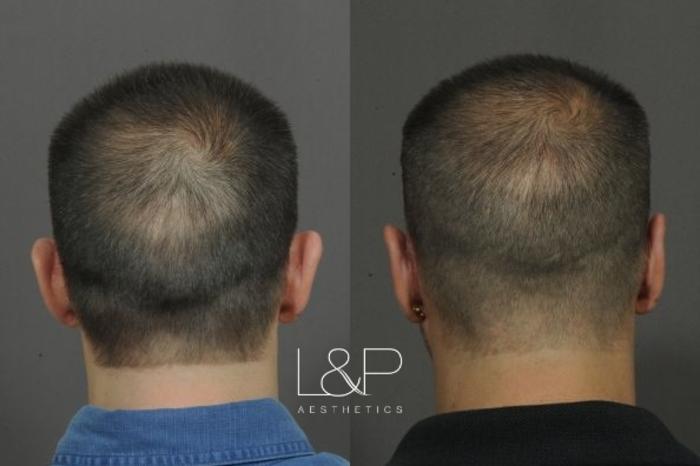 Before & After Otoplasty Case 60 Back View in Palo Alto & San Jose, California