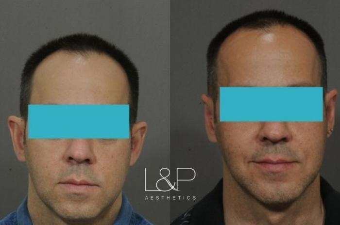 Before & After Otoplasty Case 60 Front View in Palo Alto & San Jose, California