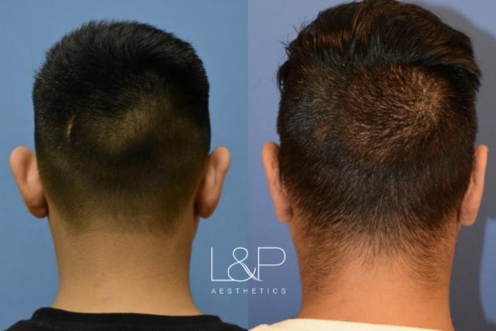 Before & After Otoplasty Case 61 Back View in Palo Alto & San Jose, California