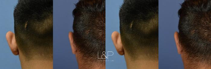 Before & After Otoplasty Case 61 Left Side View in Palo Alto & San Jose, California