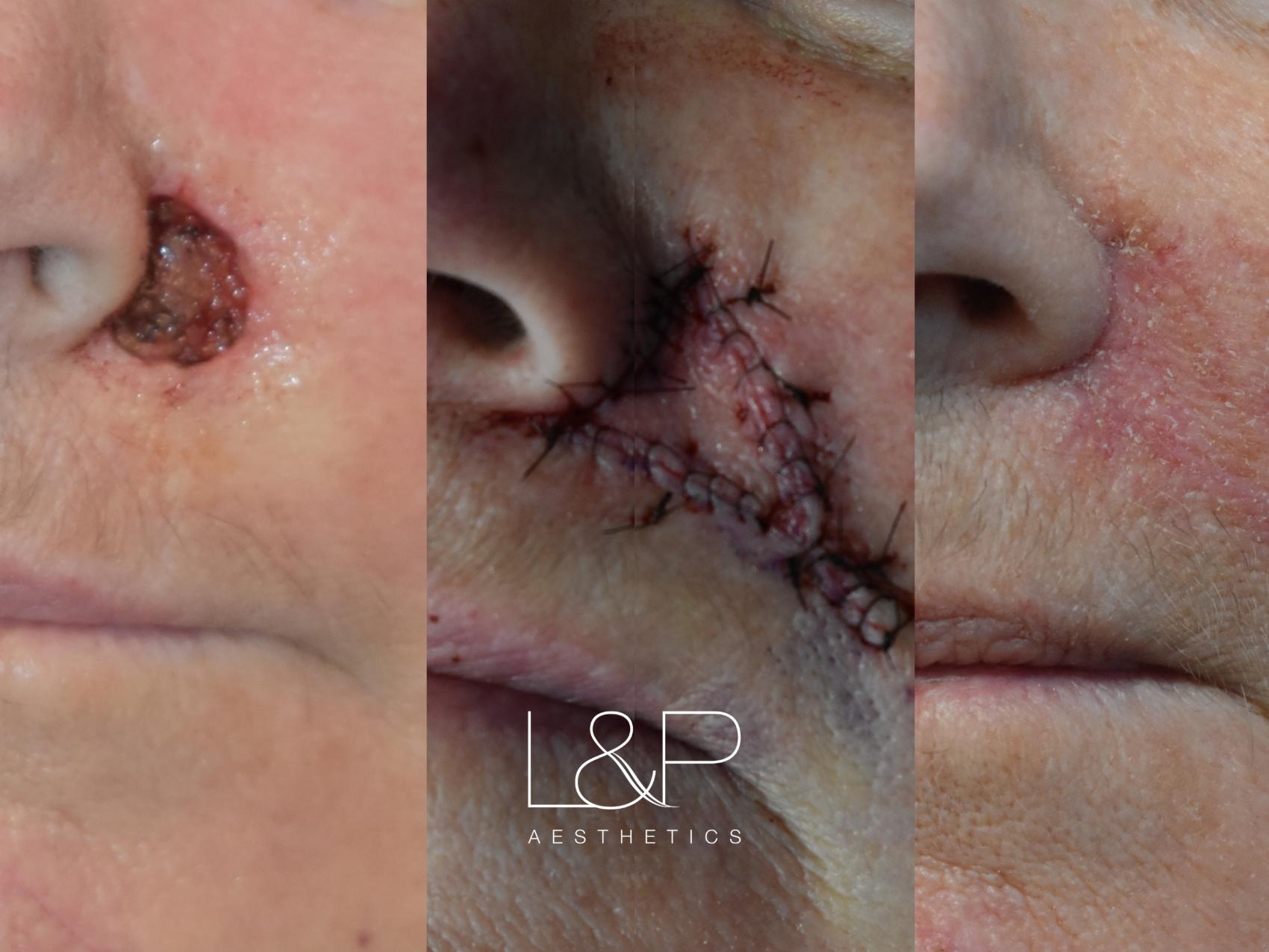 Reconstructive surgery for previous skin cancer patient