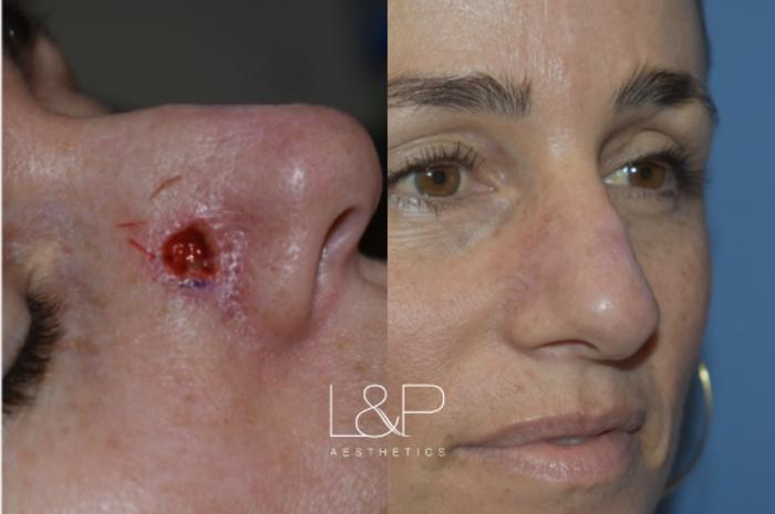 Before & After Reconstructive Surgery Case 45 Right Oblique View in Palo Alto & San Jose, California