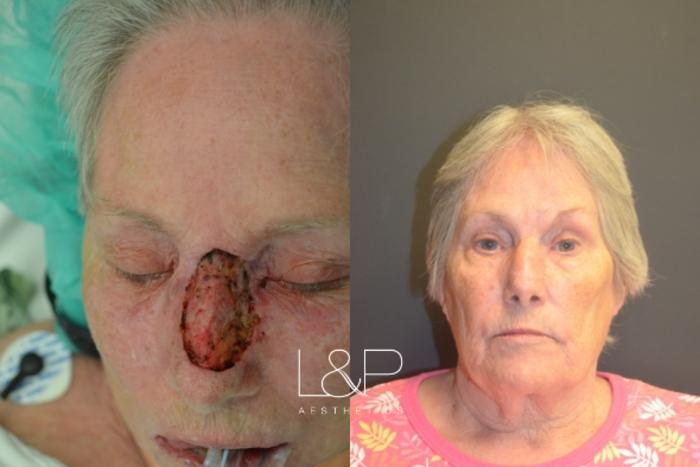 Before & After Reconstructive Surgery Case 46 Front View in Palo Alto & San Jose, California