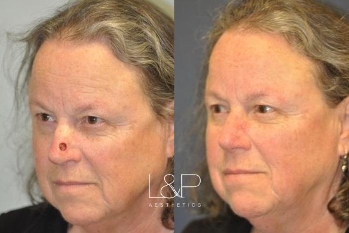 Before & After Reconstructive Surgery Case 47 Left Oblique View in Palo Alto & San Jose, California