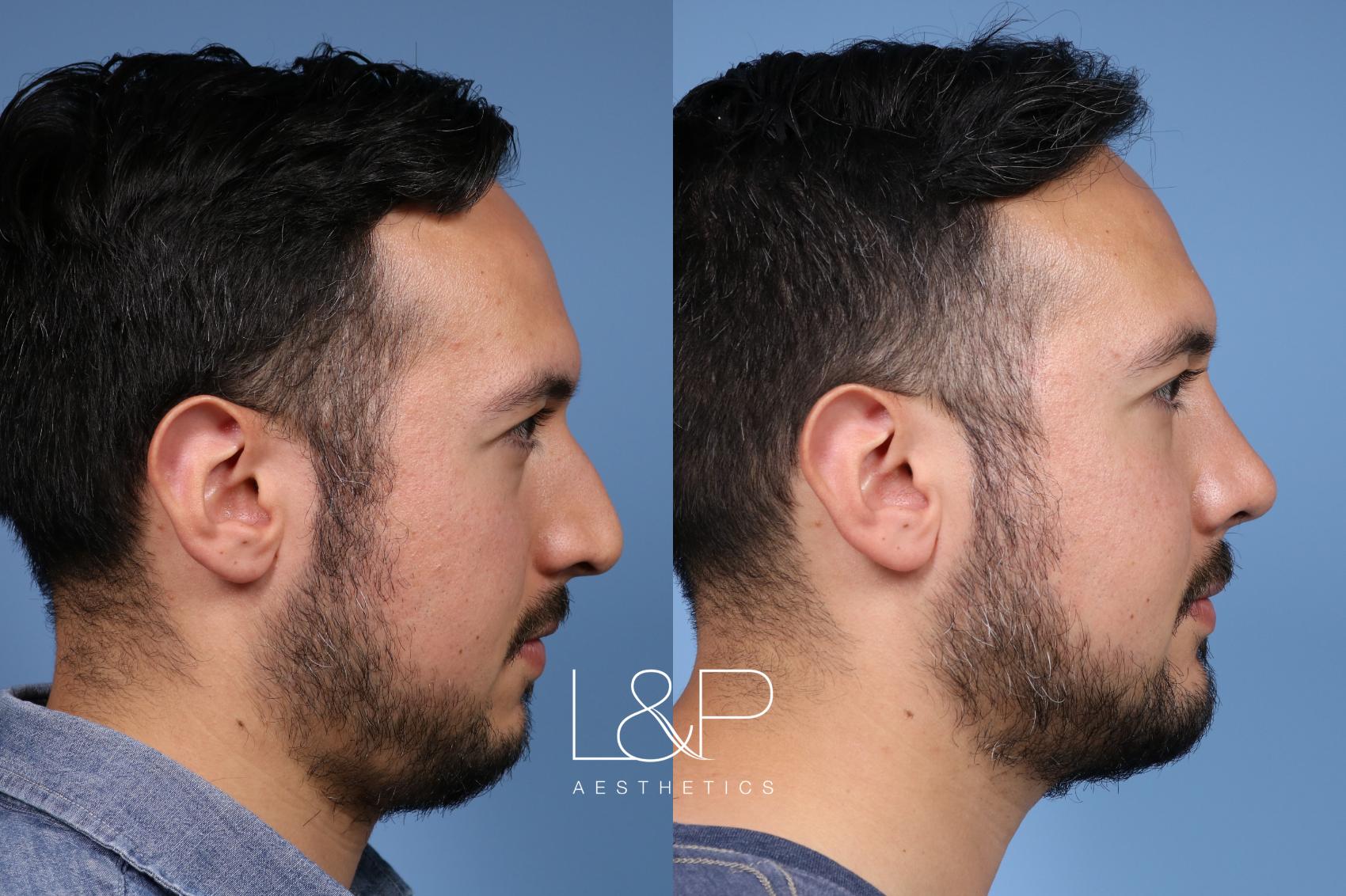 A subtle and masculine change for this man with a rhinoplasty and chin ...