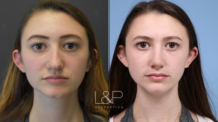 Young Bay Area Woman receives L&P Rhinoplasty 